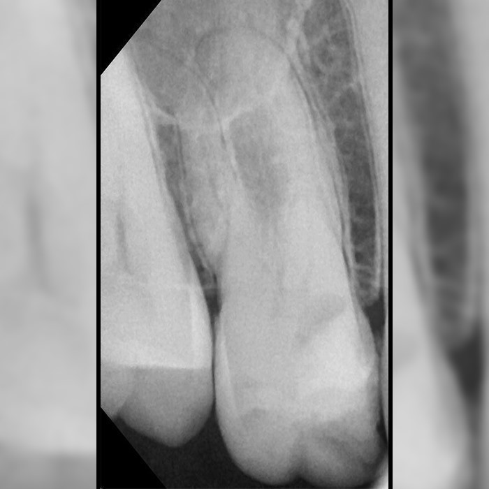 Long and calcified maxillary first molar