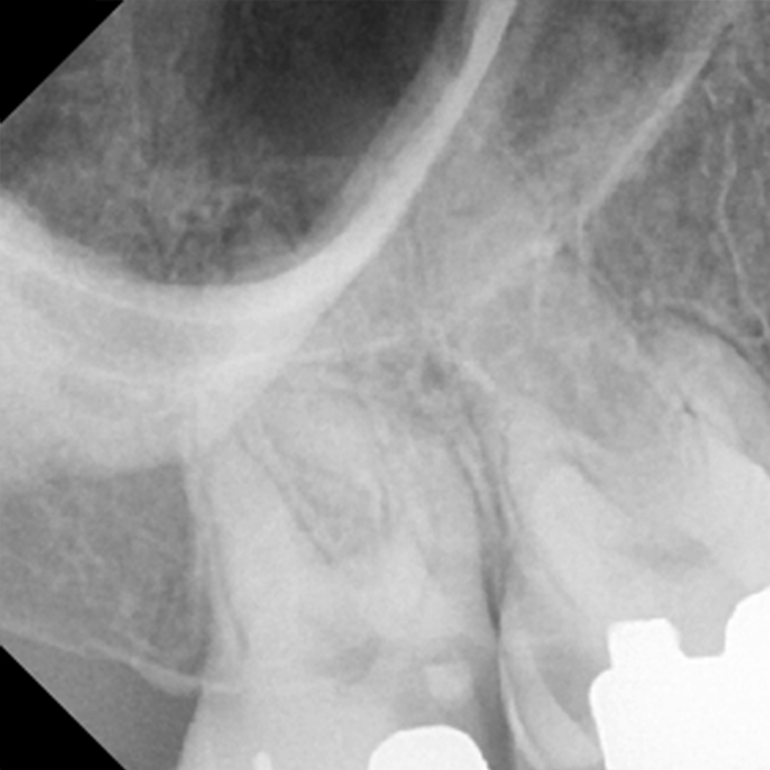 Complicated root canal in an anxious patient