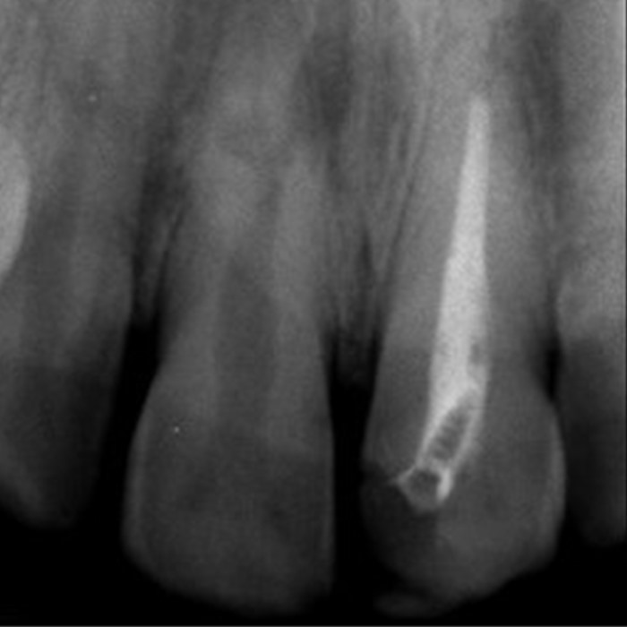 10 year Recall Internal Resorption