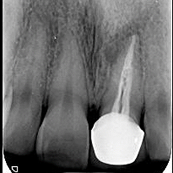 4 year Recall Surgical retreatment of my own failure