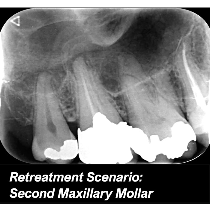 Retreatment Scenario: Second Maxillary Mollar