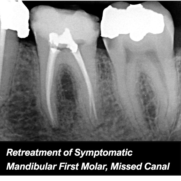 Retreatment of Symptomatic  Mandibular First Molar, Missed Canal