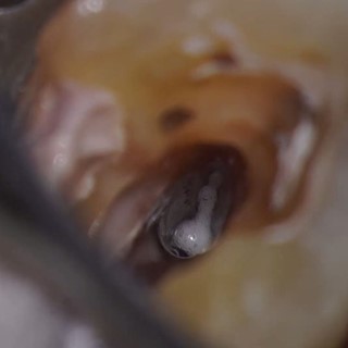 Deep Split In Second Maxillary Molar