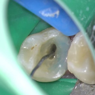 Mandibular Premolar with Complex Anatomy
