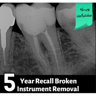 5 Year Recall Broken Instrument Removal 