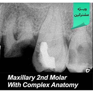 Maxillary Second Molar with Complex Anatomy 