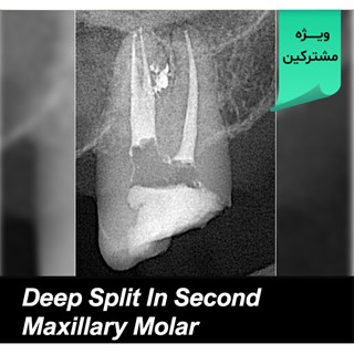 Deep Split In Second Maxillary Molar