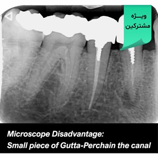 Microscope Disadvantage: Small piece of Gutta-Perchain the canal