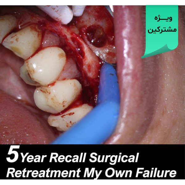   5 Year Recall Surgical Retreatment (My Own Failure)